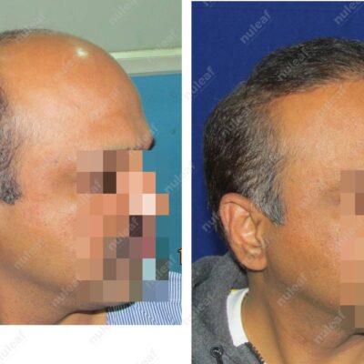 High Grade Hair Transplant