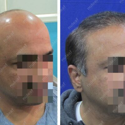 High Grade Hair Transplant