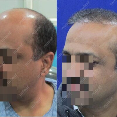 High Grade Hair Transplant