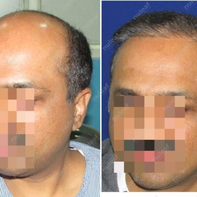 High Grade Hair Transplant