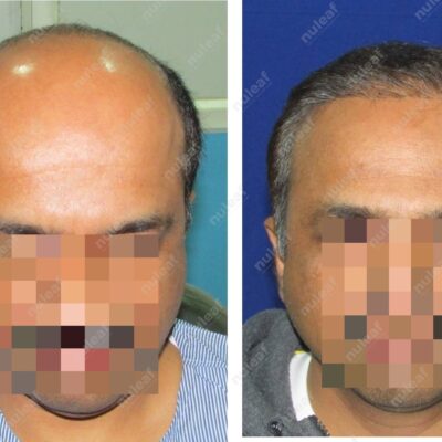 High Grade Hair Transplant