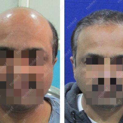 High Grade Hair Transplant