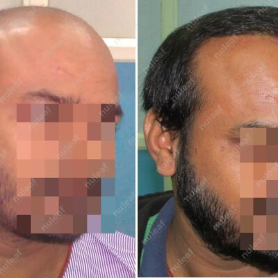 High Grade Hair Transplant