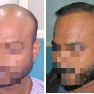 High Grade Hair Transplant