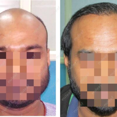 High Grade Hair Transplant