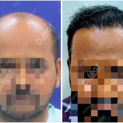 High Grade Hair Transplant