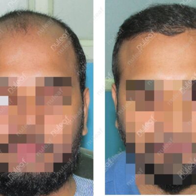 High Grade Hair Transplant