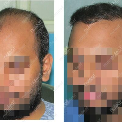 High Grade Hair Transplant