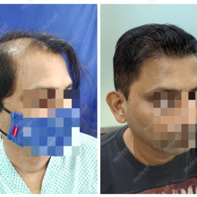 High Grade Hair Transplant