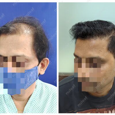 High Grade Hair Transplant