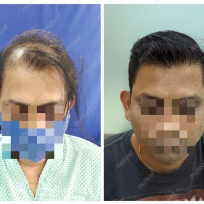 High Grade Hair Transplant