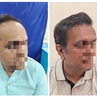 High Grade Hair Transplant