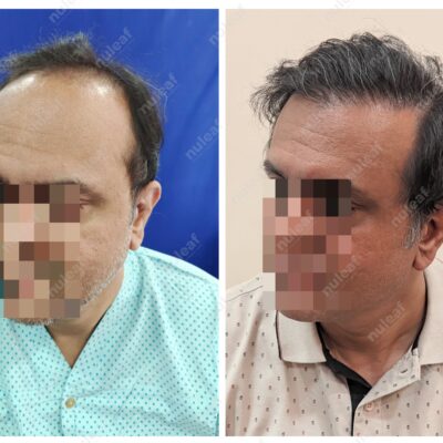 High Grade Hair Transplant