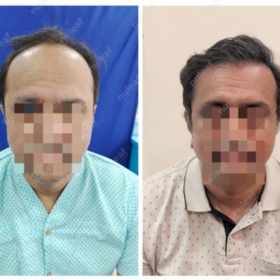 High Grade Hair Transplant