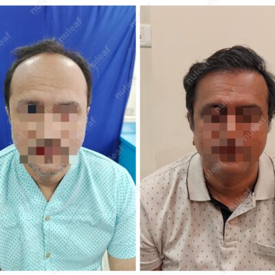 High Grade Hair Transplant