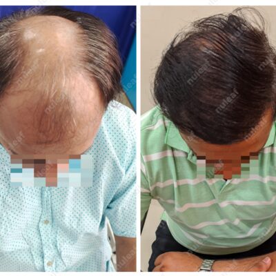 High Grade Hair Transplant