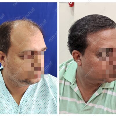 High Grade Hair Transplant