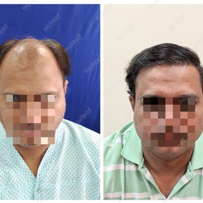 High Grade Hair Transplant