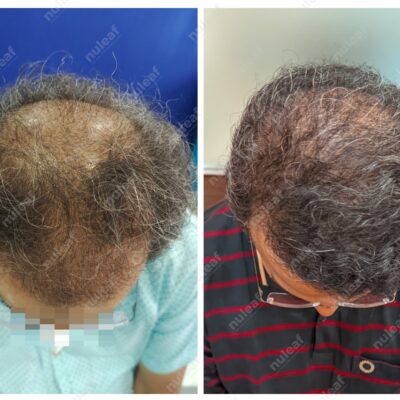 High Grade Hair Transplant