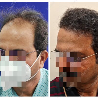 High Grade Hair Transplant