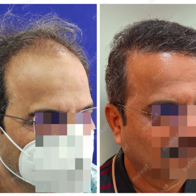 High Grade Hair Transplant