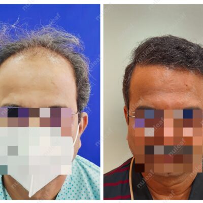 High Grade Hair Transplant