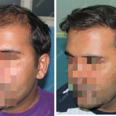 Frontal Area Hair Transplant in Pune