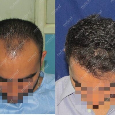 Frontal Area Hair Transplant in Pune