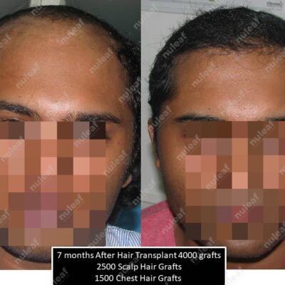 Frontal Area Hair Transplant in Pune