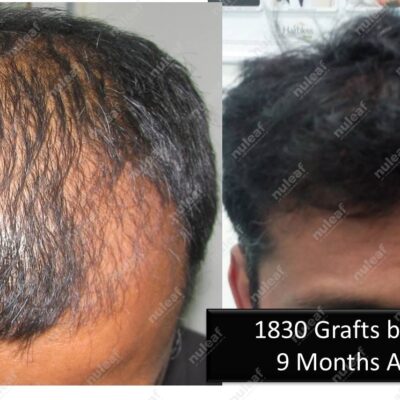 Frontal Area Hair Transplant in Pune