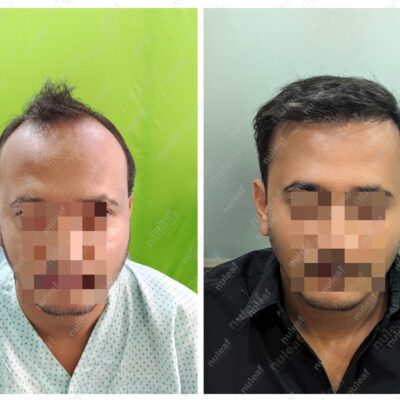 Frontal Area Hair Transplant in Pune