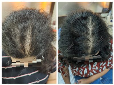 Female Pattern Hair Loss