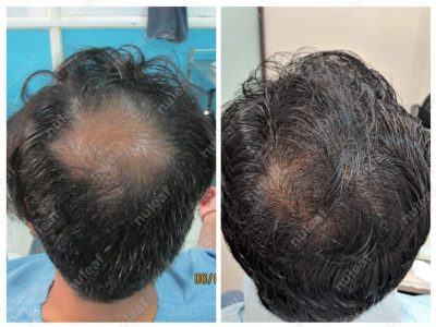 Crown area hair transplant at Nuleaf Pune