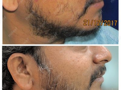 Beard Hair Transplant