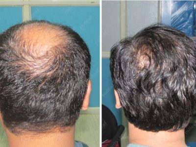 Crown area hair transplant at Nuleaf Pune