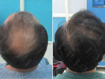 Crown area hair transplant at Nuleaf Pune