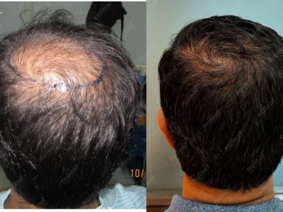 Crown area hair transplant at Nuleaf Pune