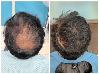 Crown area hair transplant at Nuleaf Pune