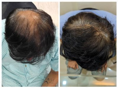 Crown area hair transplant at Nuleaf Pune