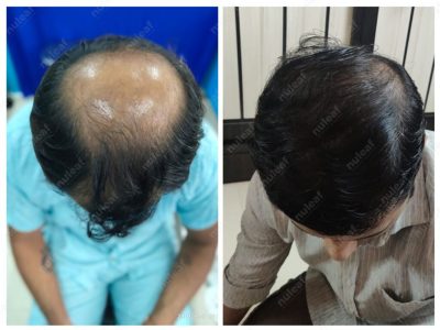Crown area hair transplant at Nuleaf Pune