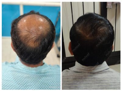 Crown area hair transplant at Nuleaf Pune