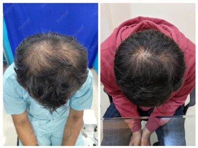 Crown area hair transplant at Nuleaf Pune
