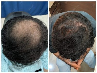 Crown area hair transplant at Nuleaf Pune