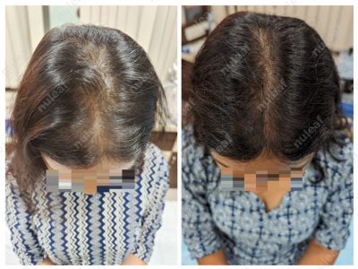 Female Pattern Hair Loss