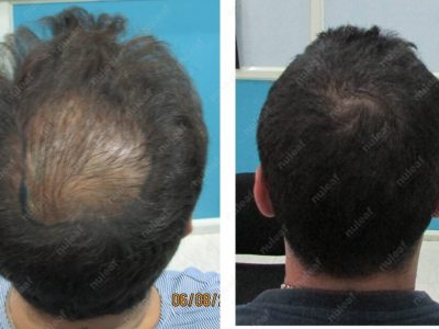 Crown area hair transplant at Nuleaf Pune