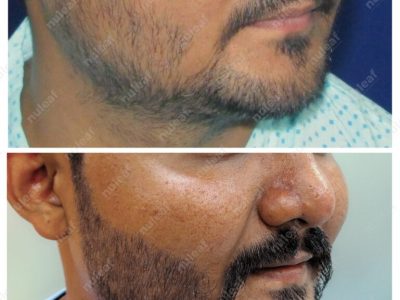 Beard Hair Transplant