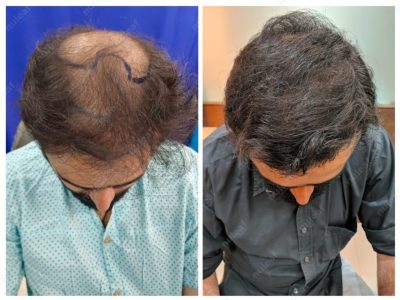 Crown area hair transplant at Nuleaf Pune