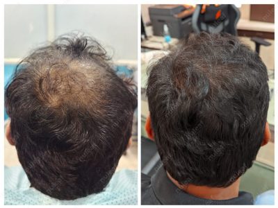Crown area hair transplant at Nuleaf Pune