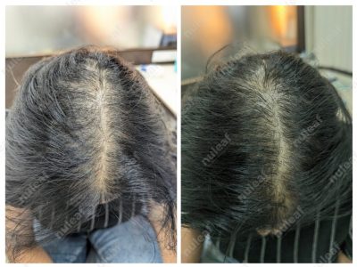 Female Pattern Hair Loss