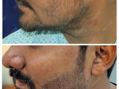 Beard Hair Transplant
